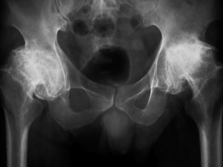 Valutazione di mialgia tensiva